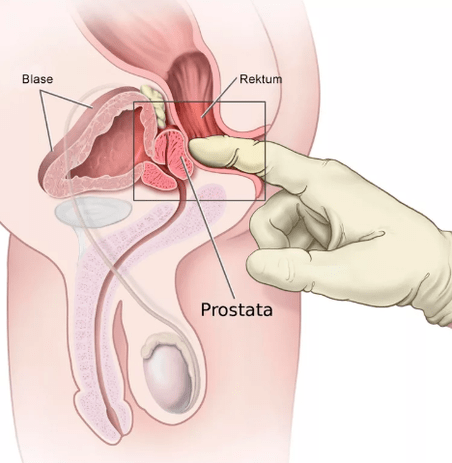 Masaj de prostată